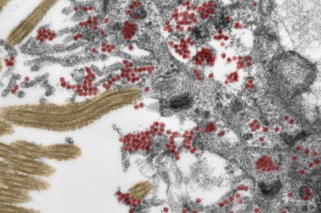 Particelle di coronavirus SARS–CoV–2 (in rosso) invadono una cellula ciliata della mucosa olfattiva. Credit: Michael Laue / RKI e Carsten Dittmayer / Charité