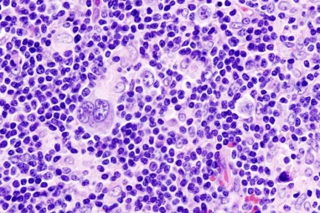 Immagine istopatologica del linfoma di Hodgkin