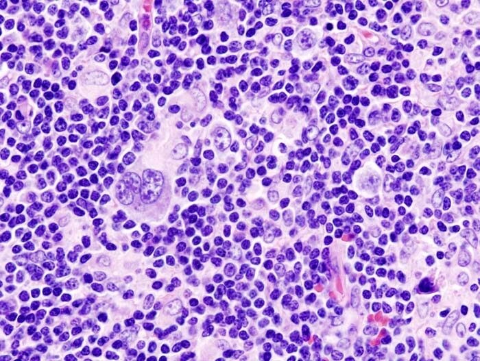 Immagine istopatologica del linfoma di Hodgkin