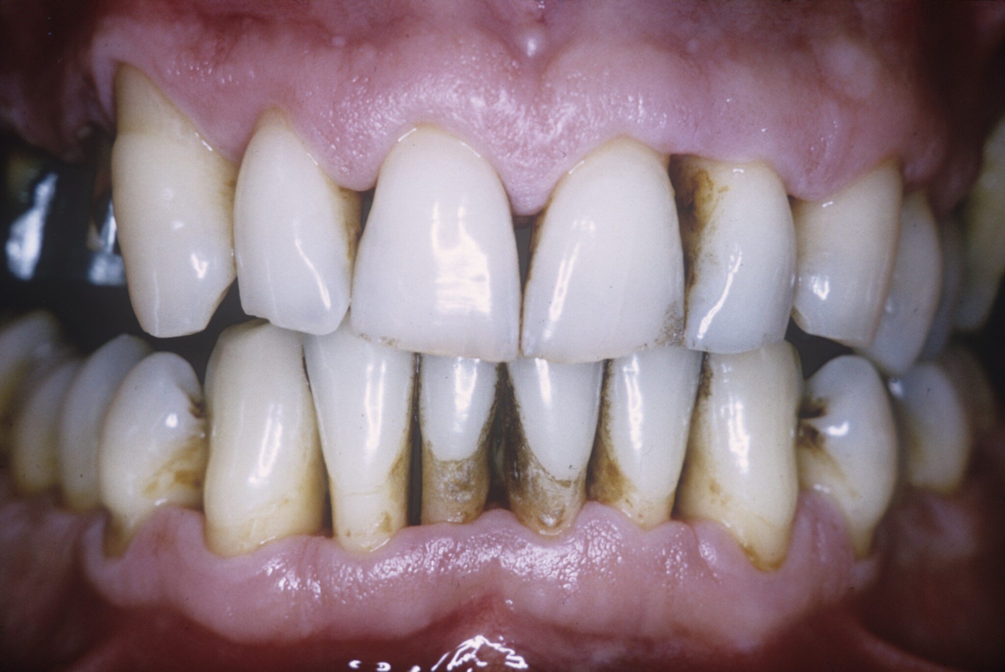 Gengive retratte in una persona con malattia parodontale / MSD GREEN/CNRI/SCIENCE PHOTO LIBRARY