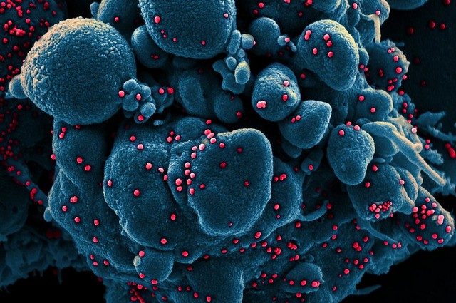 Cellula umana infettata dal coronavirus SARS–CoV–2. Credit: NIAID