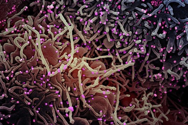 Particelle virali del coronavirus SARS–CoV–2 su cellula umana. Credit: NIAID