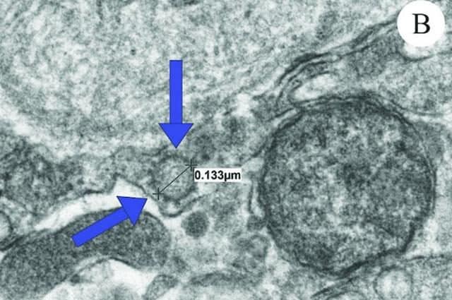 Immagini al microscopio elettronico del tessuto del pene di un paziente contagiato dal coronavirus SARS–CoV–2. Credit: Dr. Ranjith Ramasamy / University of Miami Health System