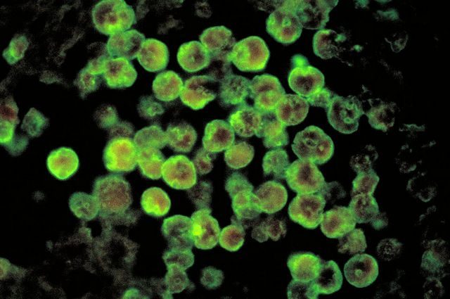 Infezione PAM. Credit: CDC/ Dr. Govinda S. Visvesvara