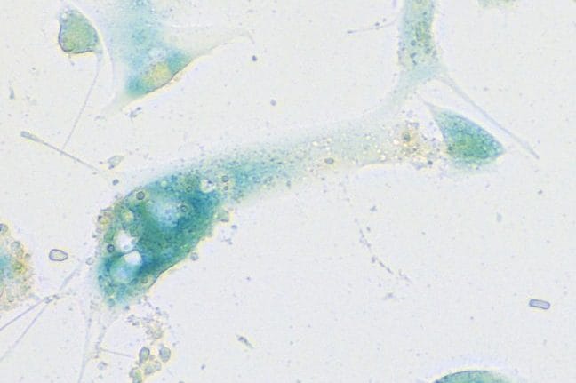 Cellule del tratto respiratorio superiore in stato di senescenza in seguito all’infezione da Sars–Cov–2 / Soyoung Lee, Charité