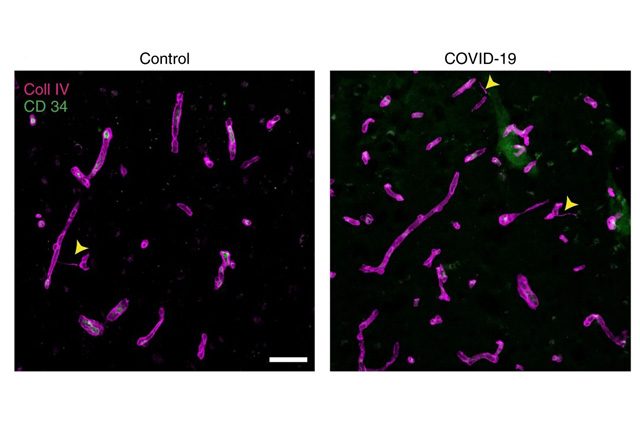 I danni ai vasi del cervello provocati dalla COVID–19. Credit: Nature neuroscience