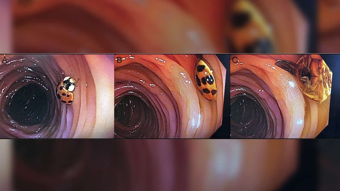 La coccinella ritrovata nell’intestino di un uomo di 59 anni, come mostrato dalla colonscopia / ACG Case Reports Journal