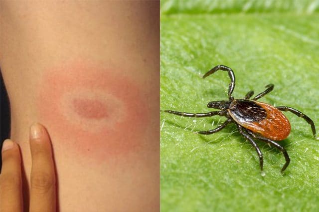 Rivoluzionario vaccino sperimentale a mRNA protegge dalla malattia di Lyme in test di laboratorio