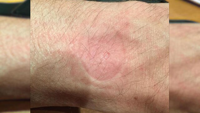 apple watch bruciatura