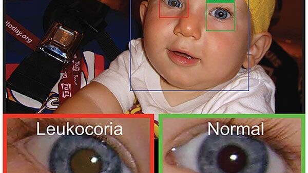 app tumore occhio